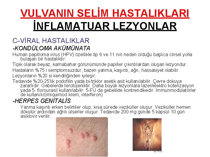 VULVANIN SELİM HASTALIKLARI İNFLAMATUAR LEZYONLAR C-VİRAL HASTALIKLAR -KONDÜLOMA AKÜMÜNATA Human papilloma virus (HPV) özellikle VULVANIN SELİM HASTALIKLARI İNFLAMATUAR LEZYONLAR C-VİRAL HASTALIKLAR -KONDÜLOMA AKÜMÜNATA Human papilloma virus (HPV) özellikle