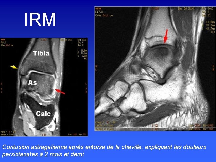 IRM Contusion astragalienne après entorse de la cheville, expliquant les douleurs persistanates à 2