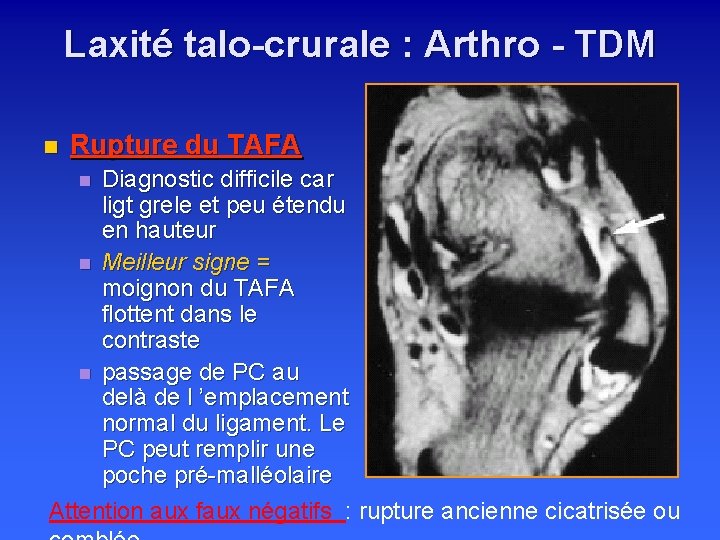 Laxité talo-crurale : Arthro - TDM n Rupture du TAFA Diagnostic difficile car ligt