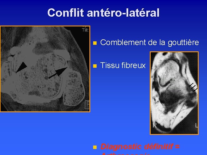 Conflit antéro-latéral n Comblement de la gouttière n Tissu fibreux n Diagnostic définitif =