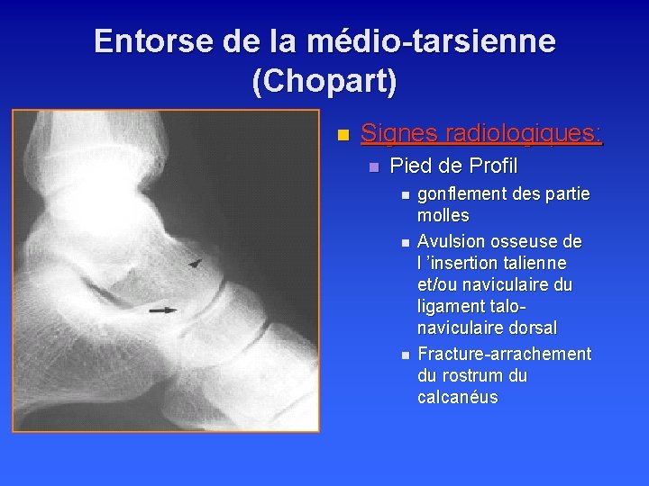 Entorse de la médio-tarsienne (Chopart) n Signes radiologiques: n Pied de Profil n n