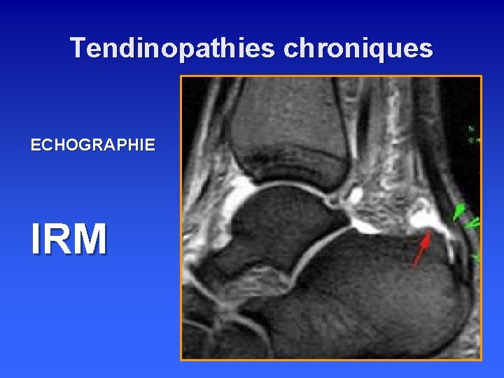 Tendinopathies chroniques ECHOGRAPHIE IRM 