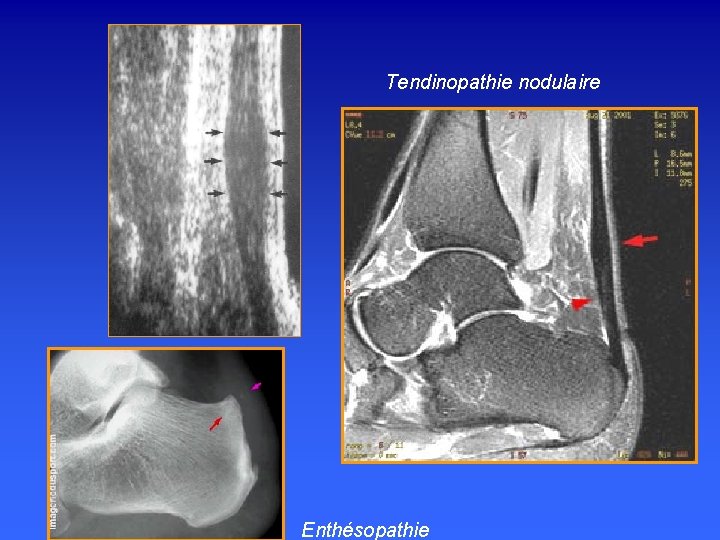 Tendinopathie nodulaire Enthésopathie 