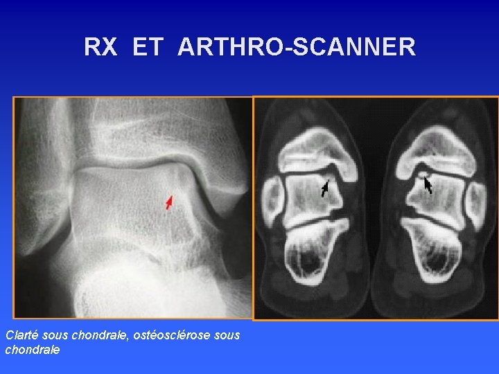 RX ET ARTHRO-SCANNER Clarté sous chondrale, ostéosclérose sous chondrale 