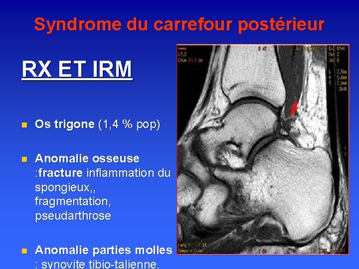 Syndrome du carrefour postérieur RX ET IRM n Os trigone (1, 4 % pop)