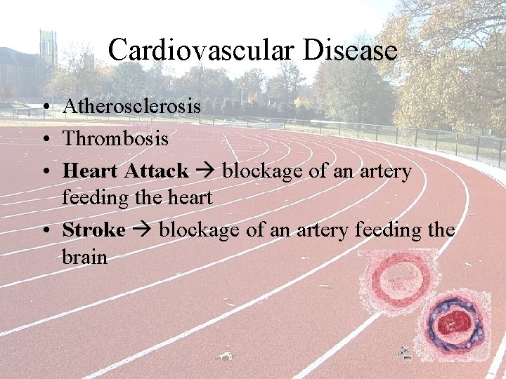 Cardiovascular Disease • Atherosclerosis • Thrombosis • Heart Attack blockage of an artery feeding