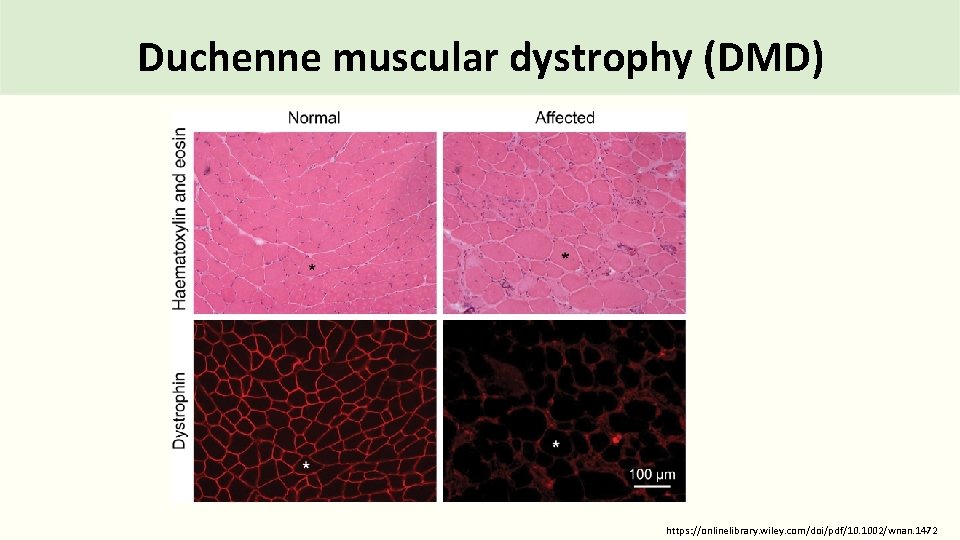 Duchenne muscular dystrophy (DMD) https: //onlinelibrary. wiley. com/doi/pdf/10. 1002/wnan. 1472 