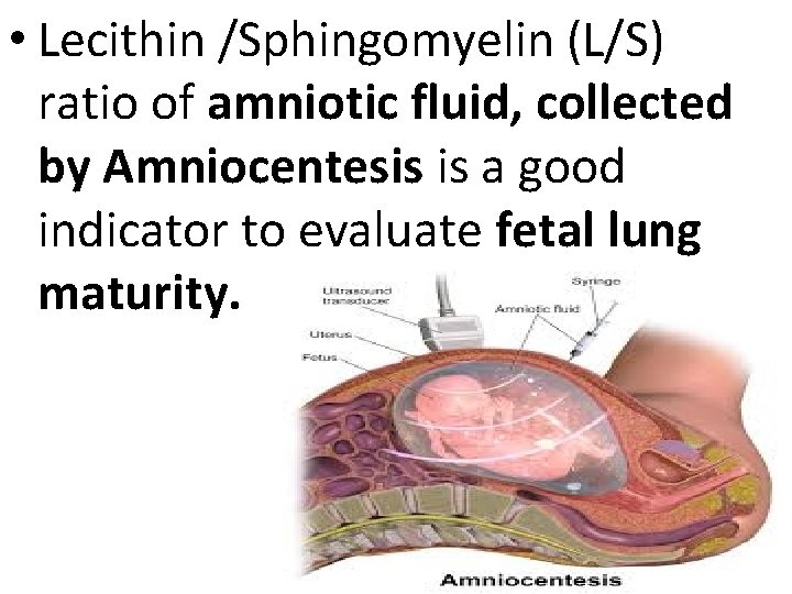  • Lecithin /Sphingomyelin (L/S) ratio of amniotic fluid, collected by Amniocentesis is a