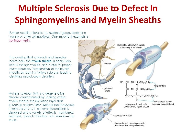 Multiple Sclerosis Due to Defect In Sphingomyelins and Myelin Sheaths 