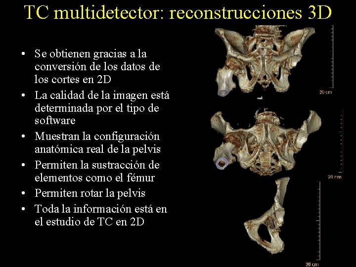 TC multidetector: reconstrucciones 3 D • Se obtienen gracias a la conversión de los