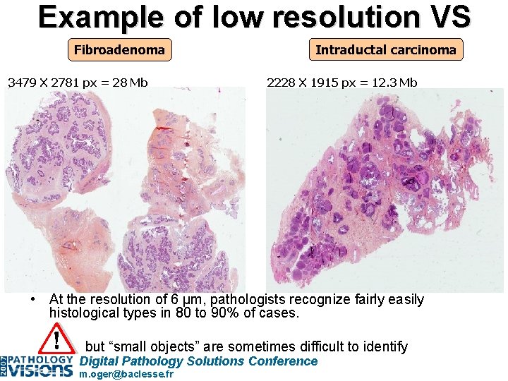 Example of low resolution VS Fibroadenoma 3479 X 2781 px = 28 Mb Intraductal