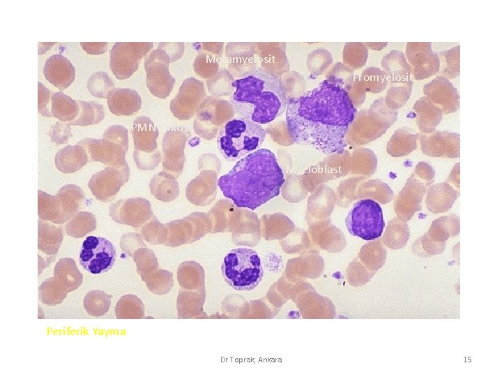 Metamyelosit Promyelosit PMN Lökosit Myeloblast Periferik Yayma Dr Toprak, Ankara 15 Metamyelosit Promyelosit PMN Lökosit Myeloblast Periferik Yayma Dr Toprak, Ankara 15
