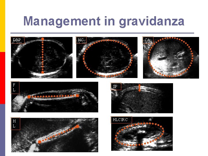 Management in gravidanza DBP HC CA F L SP H L HLCIRC 