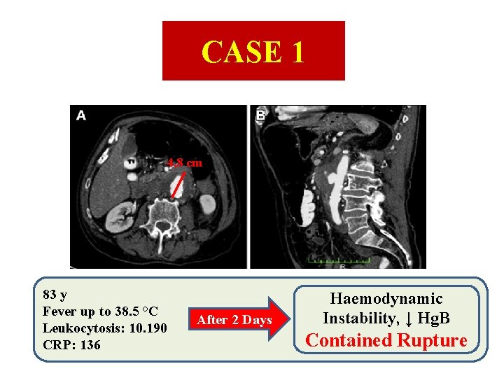 CASE 1 4, 8 cm 83 y Fever up to 38. 5 °C Leukocytosis: CASE 1 4, 8 cm 83 y Fever up to 38. 5 °C Leukocytosis: