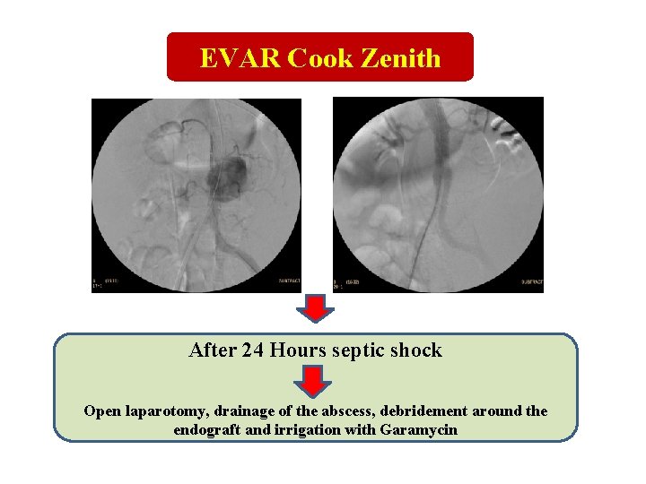 EVAR Cook Zenith After 24 Hours septic shock Open laparotomy, drainage of the abscess, EVAR Cook Zenith After 24 Hours septic shock Open laparotomy, drainage of the abscess,