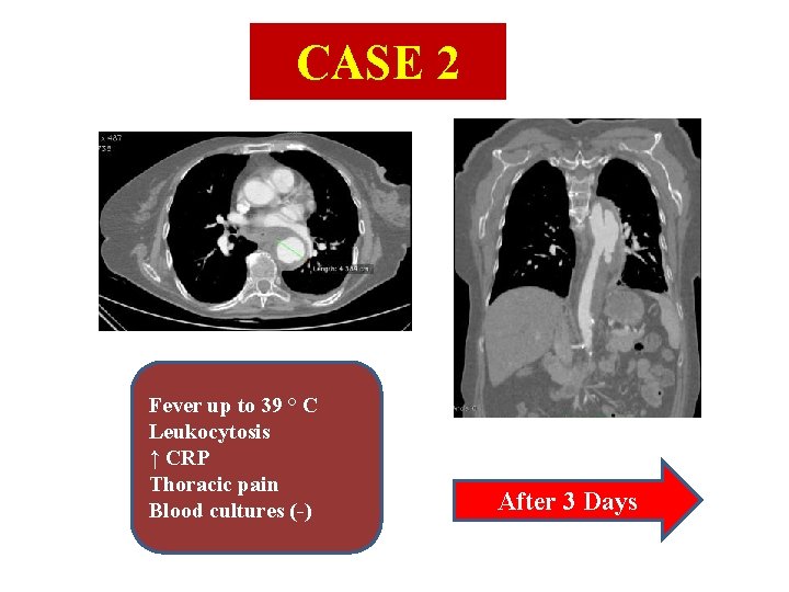 CASE 2 Fever up to 39 ° C Leukocytosis ↑ CRP Thoracic pain Blood CASE 2 Fever up to 39 ° C Leukocytosis ↑ CRP Thoracic pain Blood