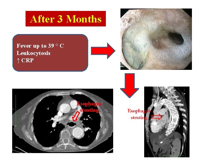 After 3 Months Fever up to 39 ° C Leukocytosis ↑ CRP Esophagus stenting After 3 Months Fever up to 39 ° C Leukocytosis ↑ CRP Esophagus stenting
