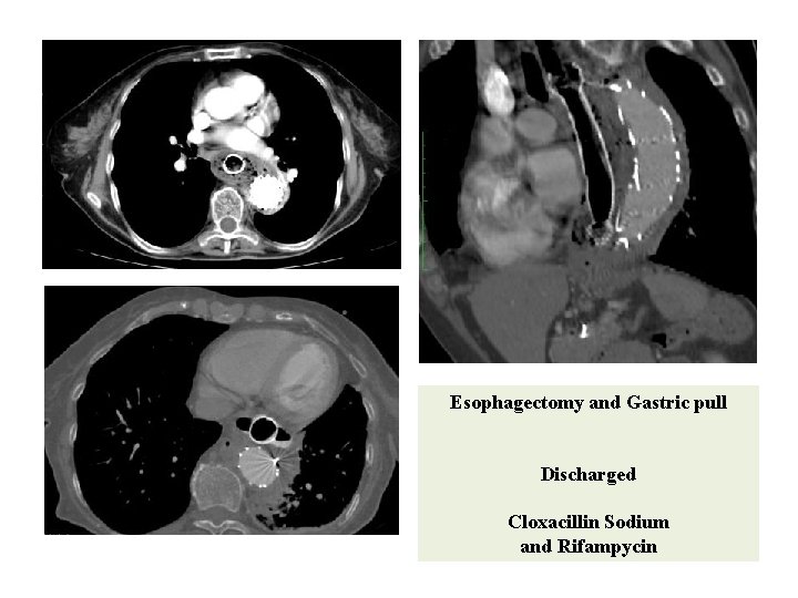 Esophagectomy and Gastric pull Discharged Cloxacillin Sodium and Rifampycin Esophagectomy and Gastric pull Discharged Cloxacillin Sodium and Rifampycin