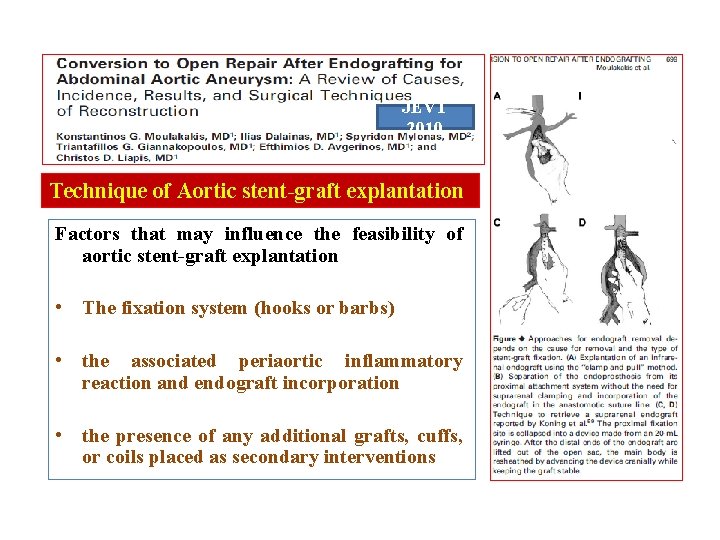 JEVT 2010 Technique of Aortic stent-graft explantation Factors that may influence the feasibility of JEVT 2010 Technique of Aortic stent-graft explantation Factors that may influence the feasibility of