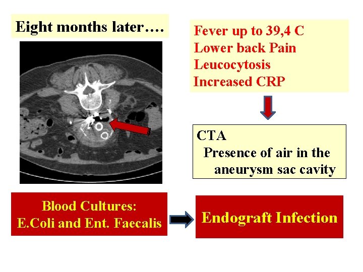 Eight months later…. Fever up to 39, 4 C Lower back Pain Leucocytosis Increased Eight months later…. Fever up to 39, 4 C Lower back Pain Leucocytosis Increased