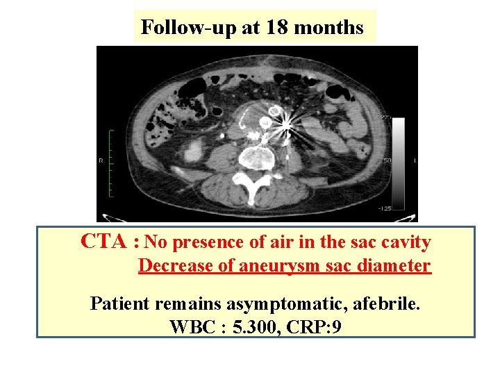 Follow-up at 18 months CTA : No presence of air in the sac cavity Follow-up at 18 months CTA : No presence of air in the sac cavity