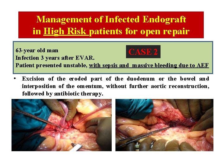 Management of Infected Endograft in High Risk patients for open repair 63 -year old Management of Infected Endograft in High Risk patients for open repair 63 -year old