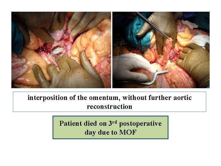 interposition of the omentum, without further aortic reconstruction Patient died on 3 rd postoperative interposition of the omentum, without further aortic reconstruction Patient died on 3 rd postoperative