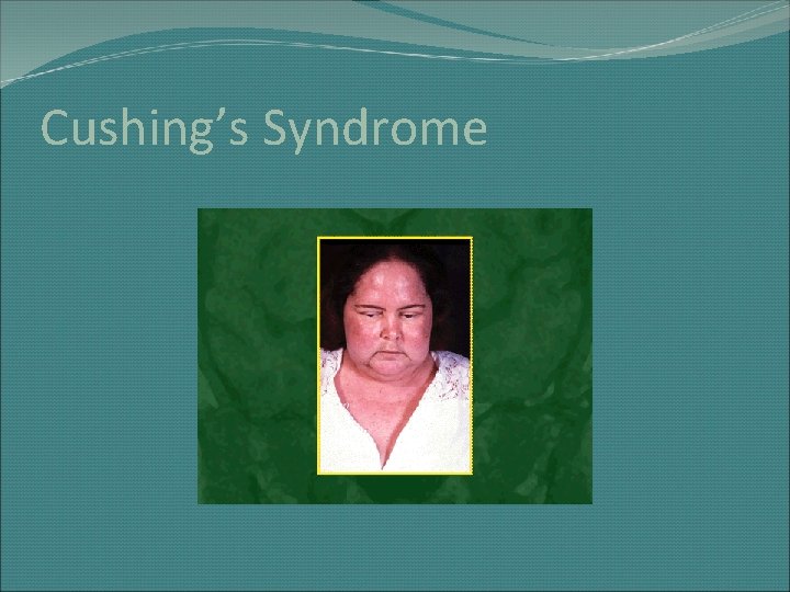 Cushing’s Syndrome 