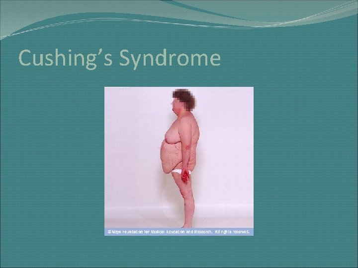 Cushing’s Syndrome 