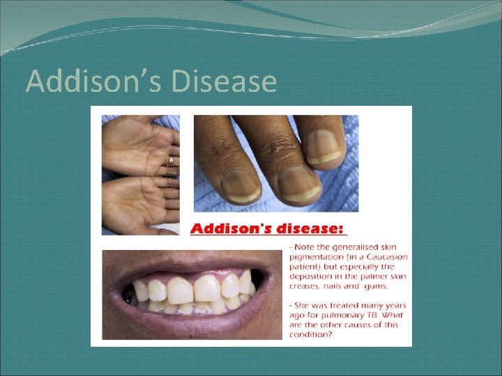 Addison’s Disease 