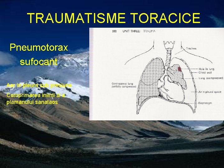 TRAUMATISME TORACICE Pneumotorax sufocant Aer in pleura sub presiune Comprimarea inimii si a plamanului