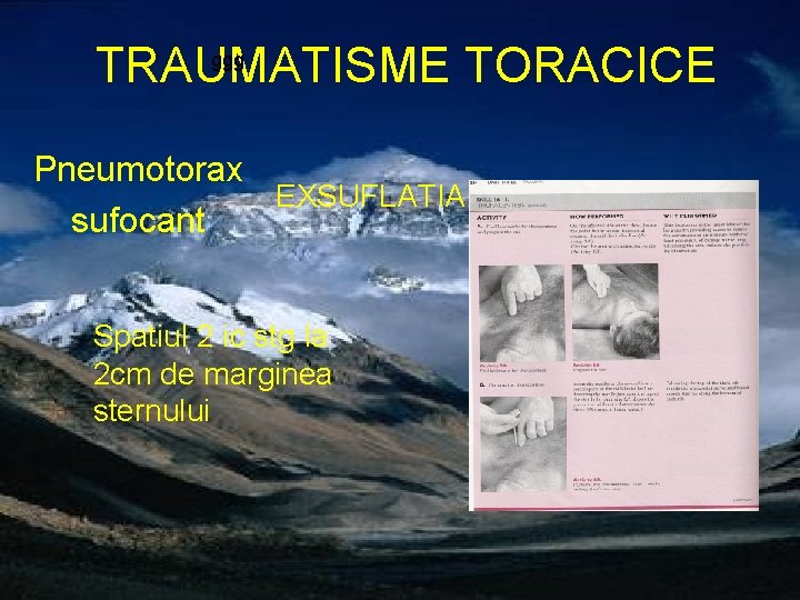 ggg TRAUMATISME TORACICE Pneumotorax EXSUFLATIA sufocant Spatiul 2 ic stg la 2 cm de