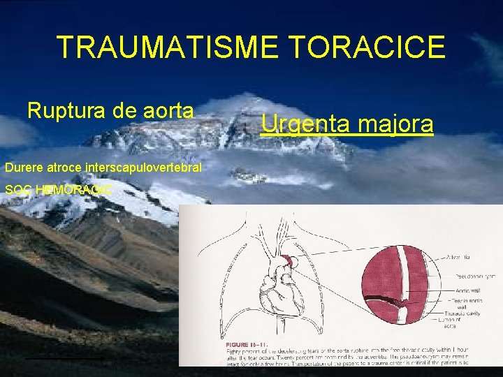 TRAUMATISME TORACICE Ruptura de aorta Durere atroce interscapulovertebral SOC HEMORAGIC Urgenta majora 