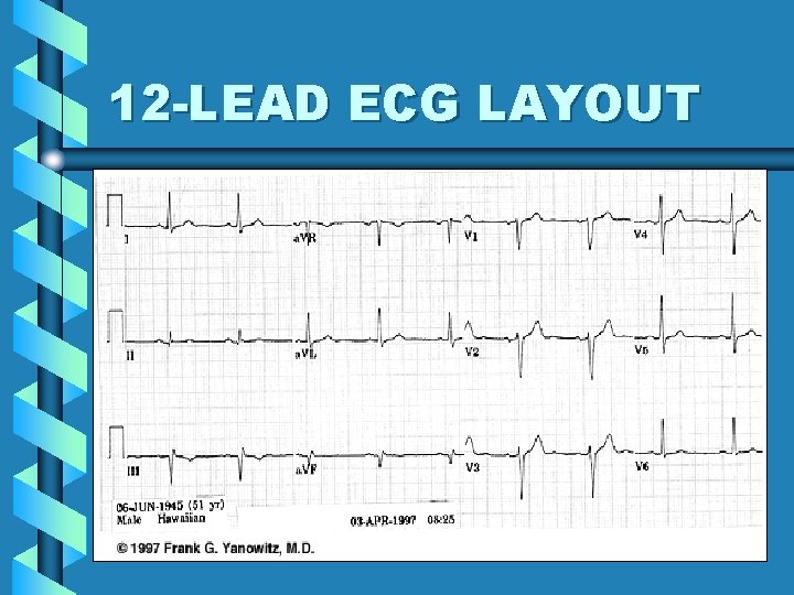 12 -LEAD ECG LAYOUT 15 12 -LEAD ECG LAYOUT 15