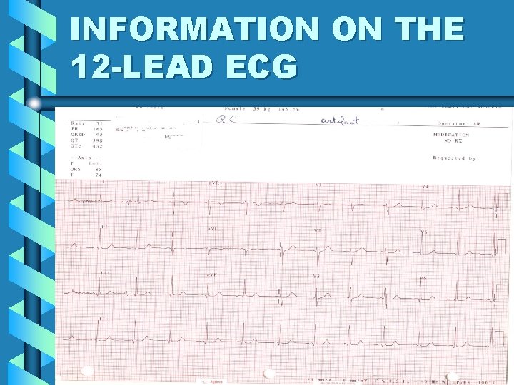 INFORMATION ON THE 12 -LEAD ECG 17 INFORMATION ON THE 12 -LEAD ECG 17