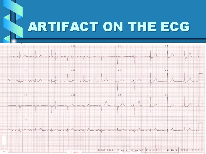 ARTIFACT ON THE ECG 30 