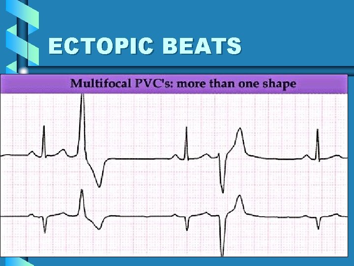 ECTOPIC BEATS 43 