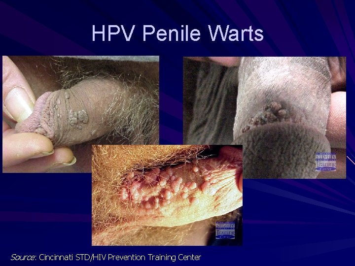 HPV Penile Warts Source: Cincinnati STD/HIV Prevention Training Center 