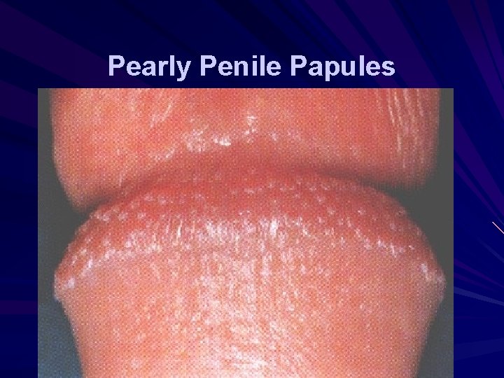 Pearly Penile Papules 