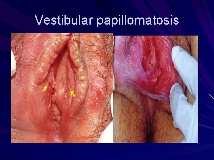 Difference between vestibular papillomatosis and genital warts - Papillomatosis x ray