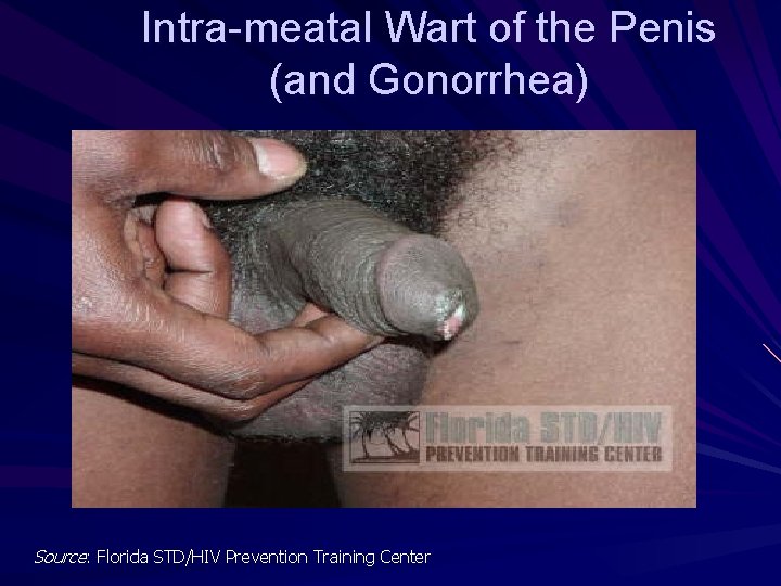 Intra-meatal Wart of the Penis (and Gonorrhea) Source: Florida STD/HIV Prevention Training Center 
