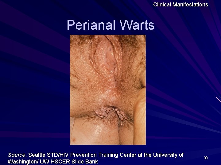 Clinical Manifestations Perianal Warts Source: Seattle STD/HIV Prevention Training Center at the University of Clinical Manifestations Perianal Warts Source: Seattle STD/HIV Prevention Training Center at the University of