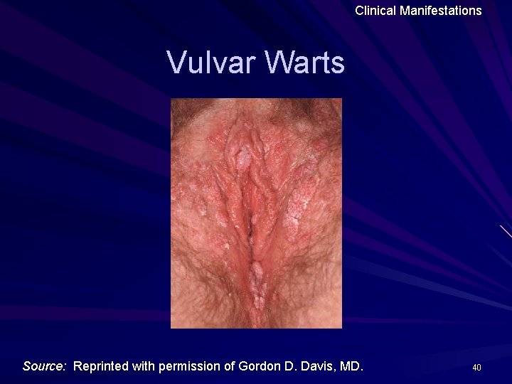 Clinical Manifestations Vulvar Warts Source: Reprinted with permission of Gordon D. Davis, MD. 40