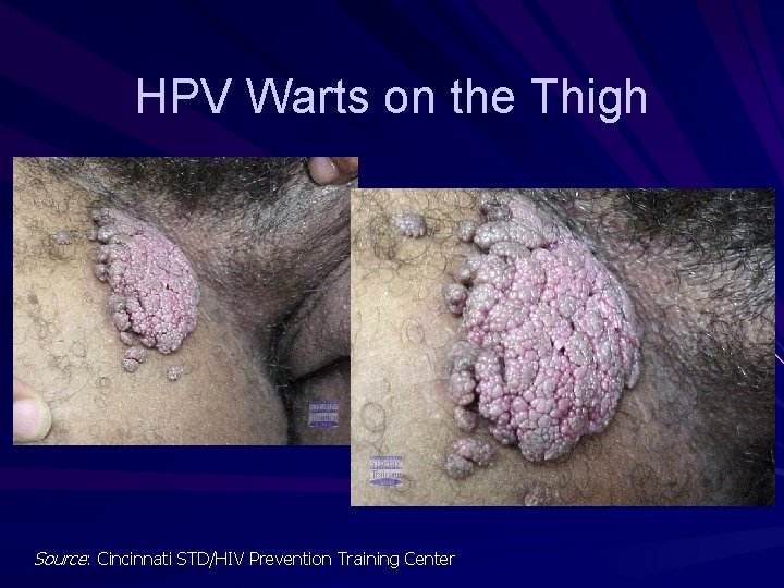 HPV Warts on the Thigh Source: Cincinnati STD/HIV Prevention Training Center HPV Warts on the Thigh Source: Cincinnati STD/HIV Prevention Training Center