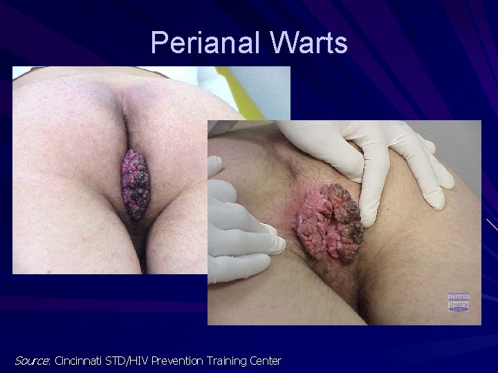 Perianal Warts Source: Cincinnati STD/HIV Prevention Training Center 