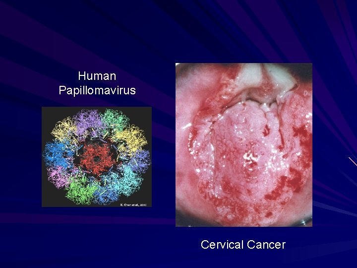 Human Papillomavirus Cervical Cancer Human Papillomavirus Cervical Cancer
