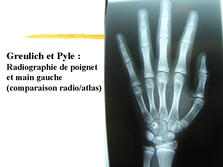 Greulich et Pyle : Radiographie de poignet et main gauche (comparaison radio/atlas) 