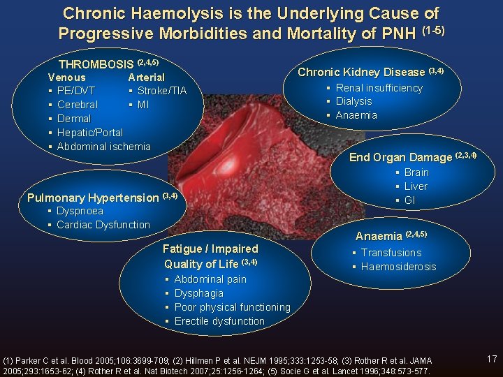 Chronic Haemolysis is the Underlying Cause of Progressive Morbidities and Mortality of PNH (1