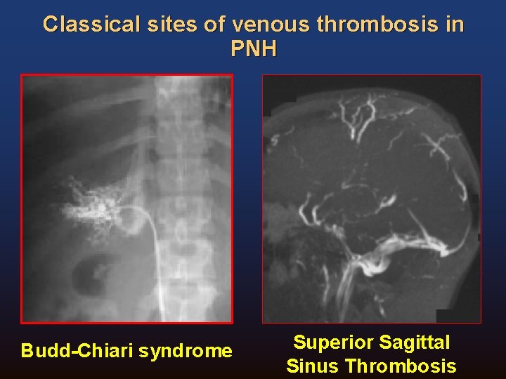 Classical sites of venous thrombosis in PNH Budd-Chiari syndrome Superior Sagittal Sinus Thrombosis 