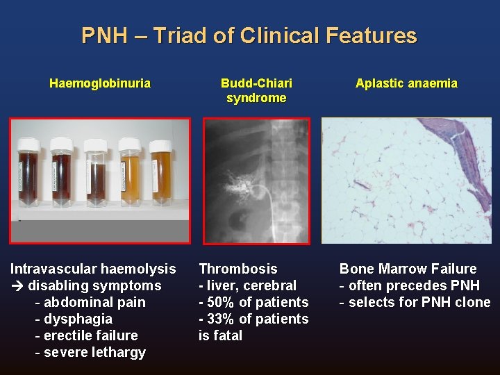 PNH – Triad of Clinical Features Haemoglobinuria Intravascular haemolysis disabling symptoms - abdominal pain